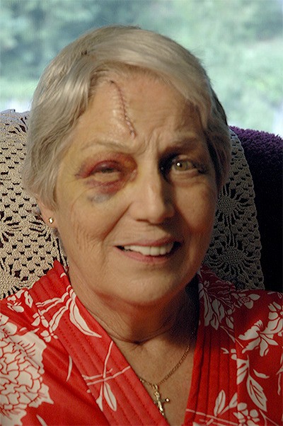 Margo Ogilvie of Smokey Point was injured during the recent windstorm when a door smacked her in the face.