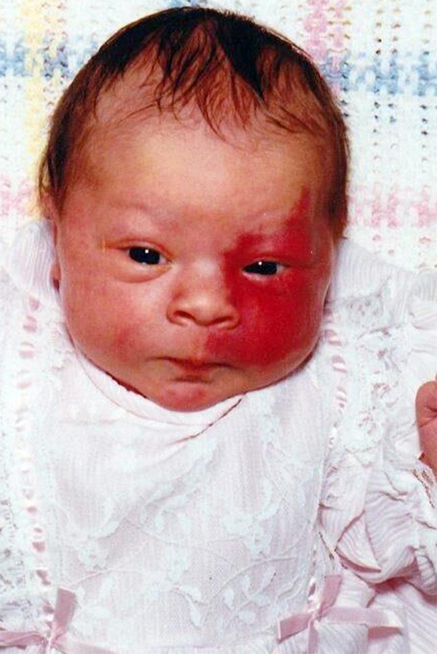 Paige's birth mark was more pronounced when she was a baby.
